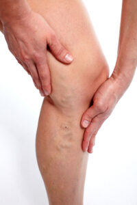 Cosmetic Surgeon near me for Varicose Vein