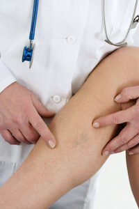 Cosmetic Surgeon near me for Varicose Vein