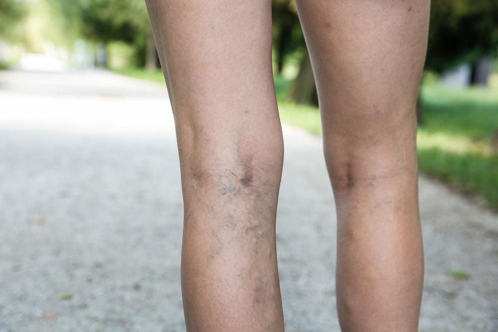 Cosmetic Surgeon near me for Varicose Vein