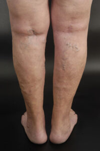 Cosmetic Surgeon near me for Varicose Vein