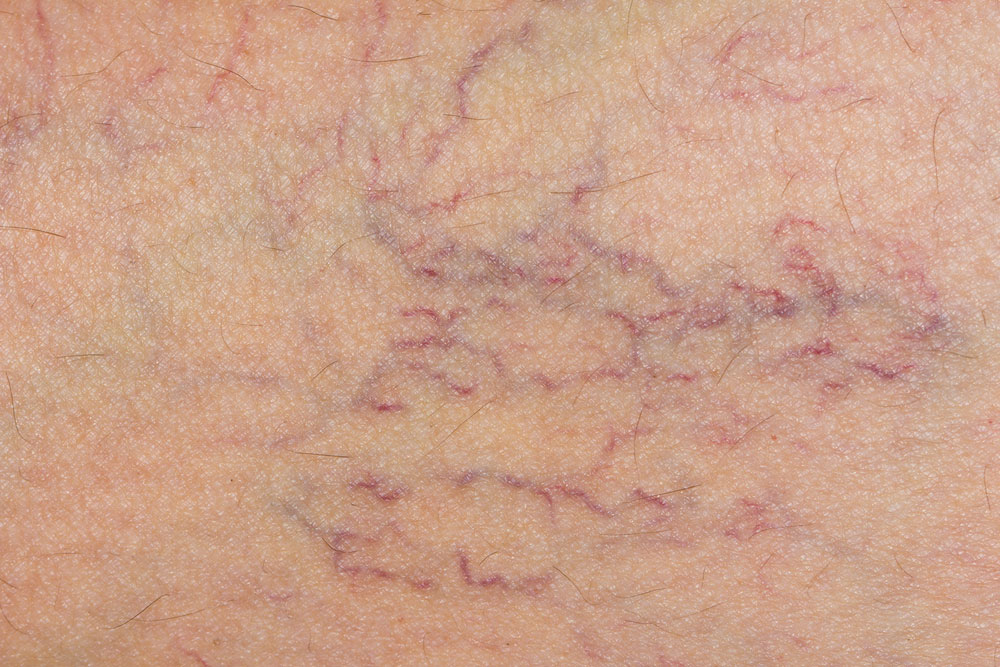 Cosmetic Surgeon near me for Varicose Vein 