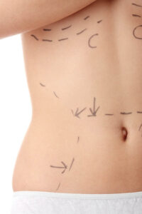 Exploring Abdominales Marcados con Liposuccion