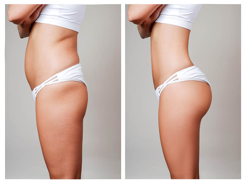 The Difference in Liposuction HD in Los Angeles