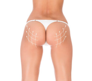 Understanding the Liposuction Procedure in Los Angeles