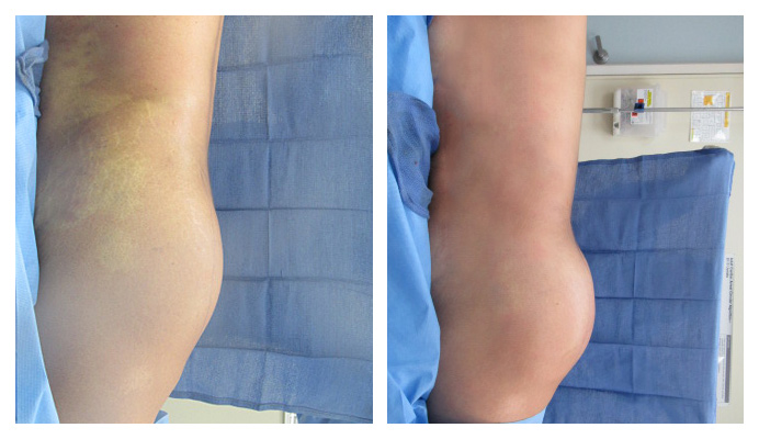 Hi Def Liposuction Los Angeles