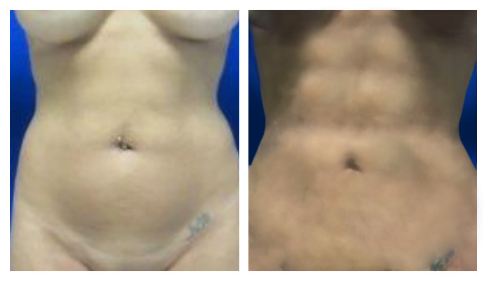 Hi Def Liposuction Los Angeles