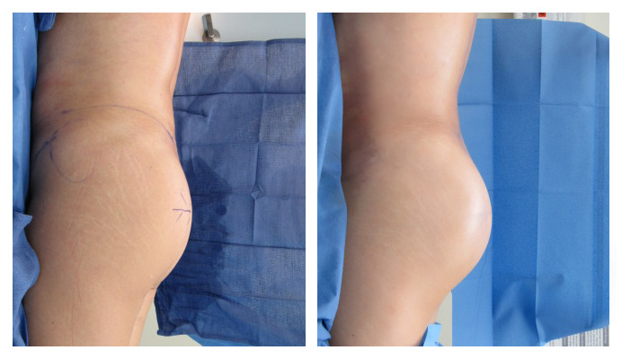 Hi Def Liposuction Los Angeles