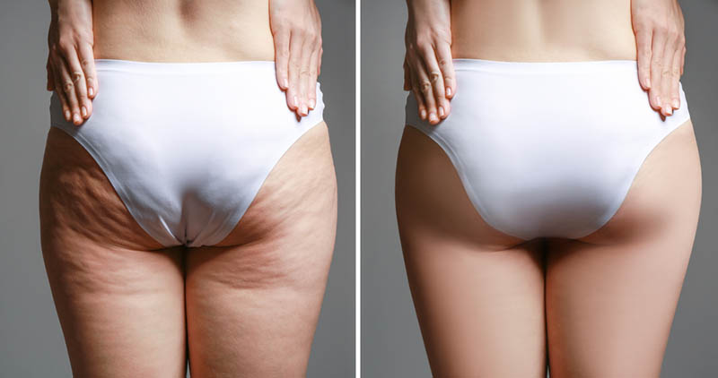 the Best Liposuction Doctors in Los Angeles