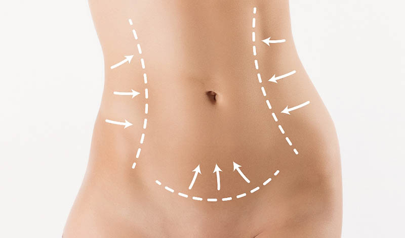 Liposuction with VASER in Los Angeles