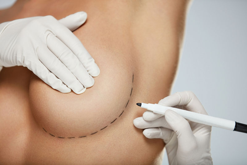 Breast Augmentation in Los Angeles