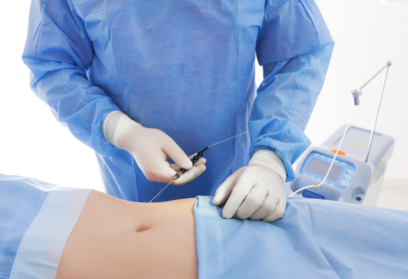 Try the Most Modern Form of Lipo in Our Los Angeles Surgery
