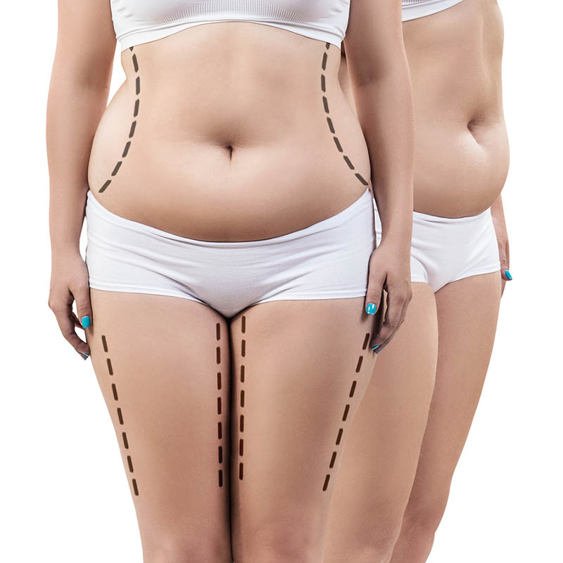 Lipo HD in Los Angeles