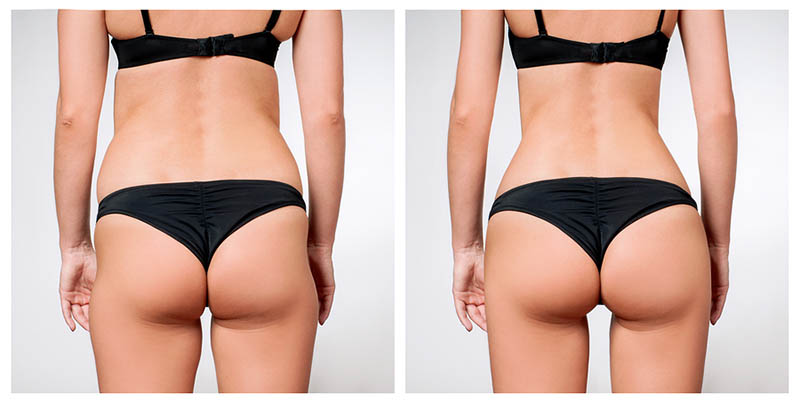 Liposuction HD in Los Angeles