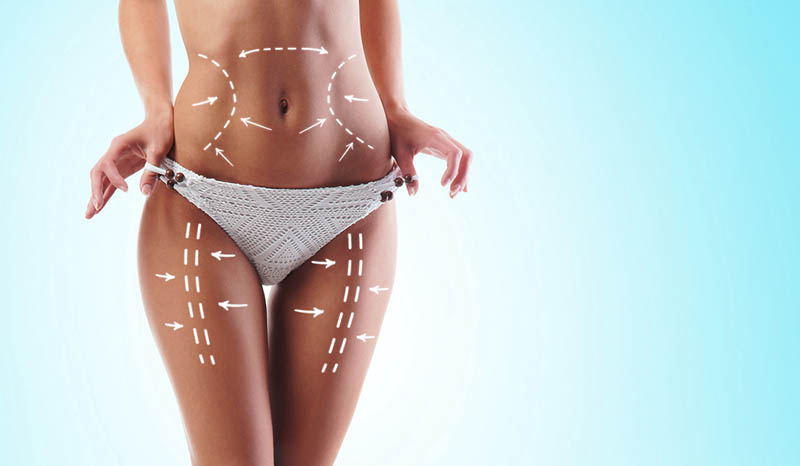 Liposuction in Los Angeles