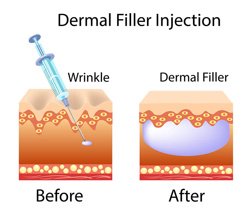 Dermal Fillers