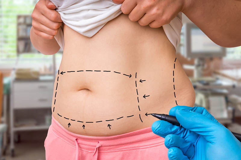 the Best Liposuction Doctors in Los Angeles