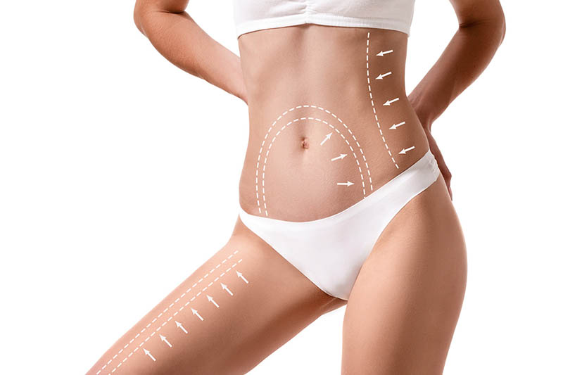 Liposuction in Los Angeles