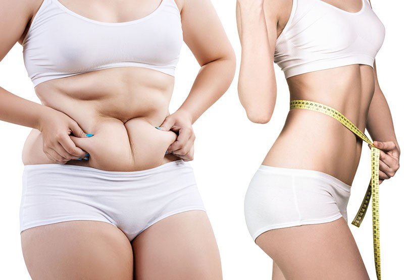 Liposuction High Definition In Los Angeles