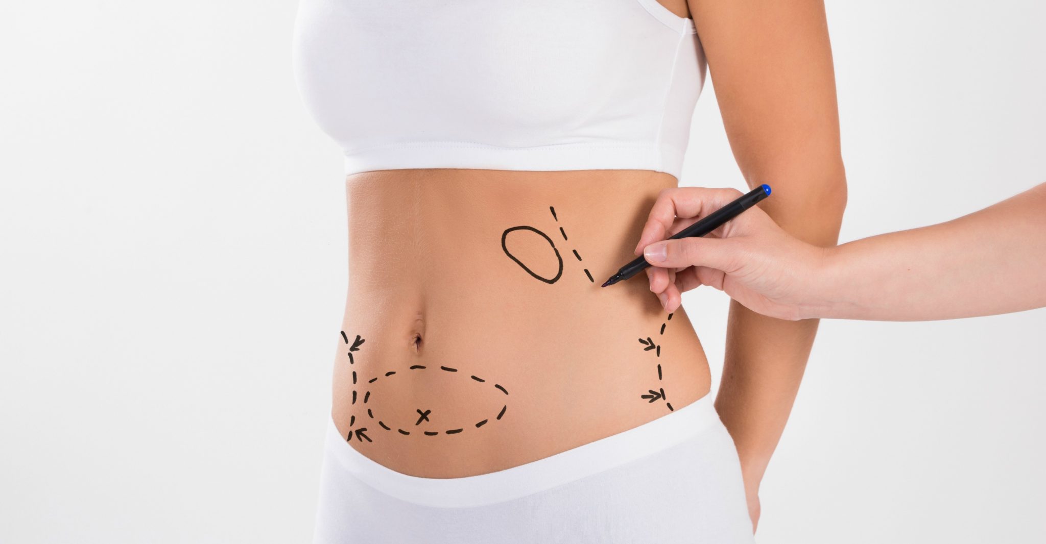 Liposuction Vaser in Los Angeles