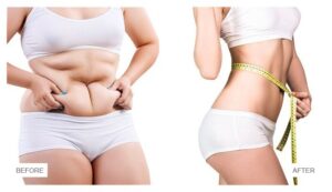 liposuction high definition for Los Angeles