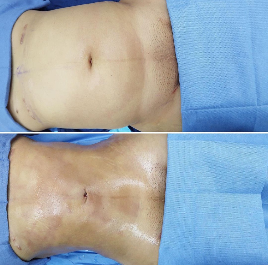 Before & After Liposuction in Los Angeles Cosmetic