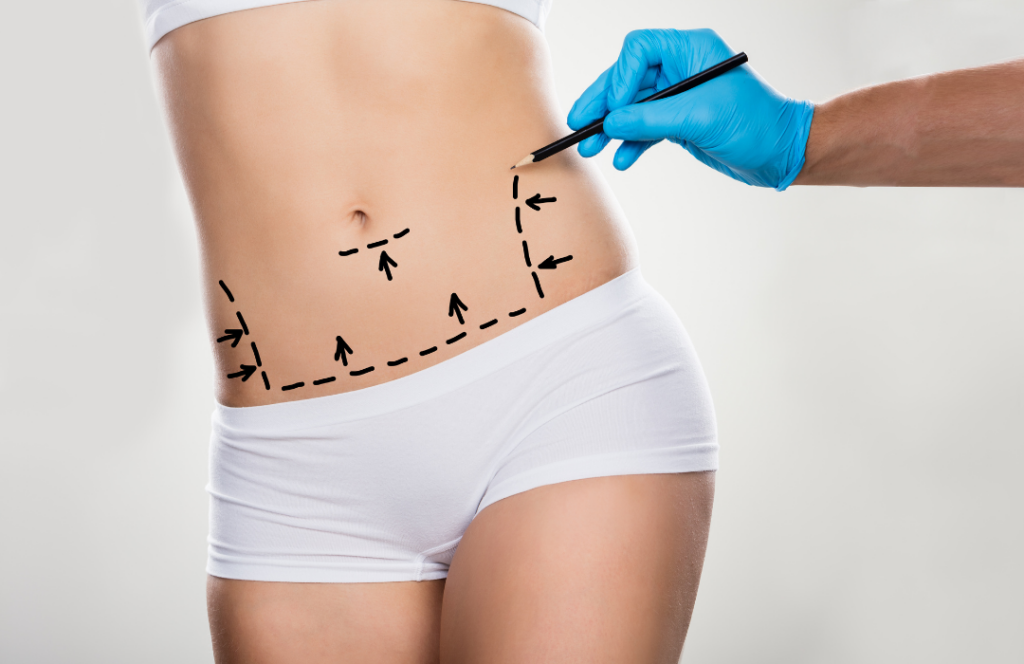 liposuction HD Los Angeles