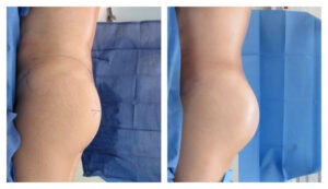 liposuction in Los Angeles