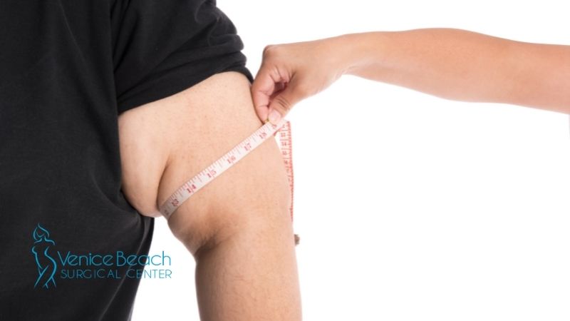 Arm Liposuction in Los Angeles