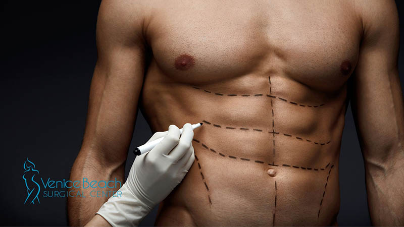 Liposuction in Los Angeles