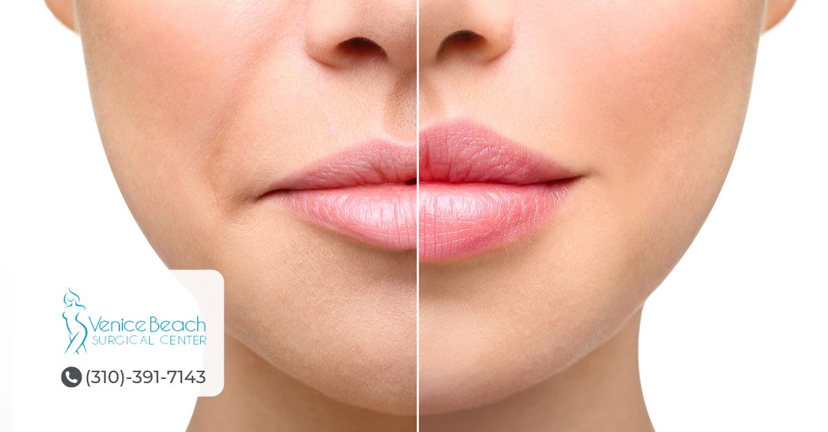 Lip Augmentation in Los Angeles