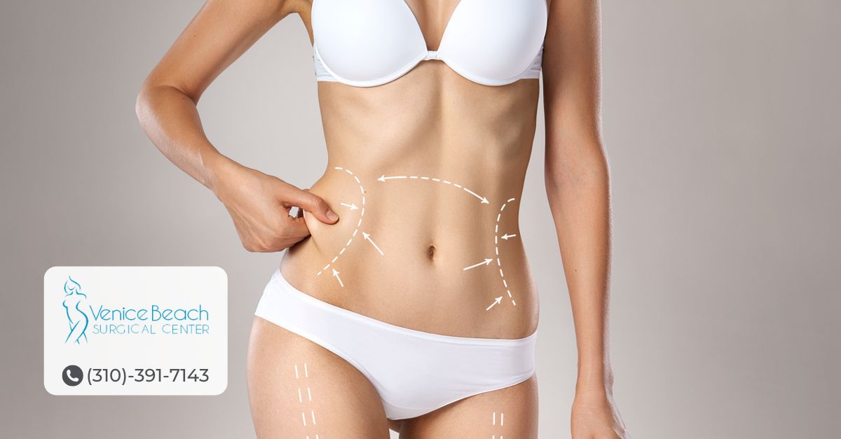 Liposuction HD in Los Angeles