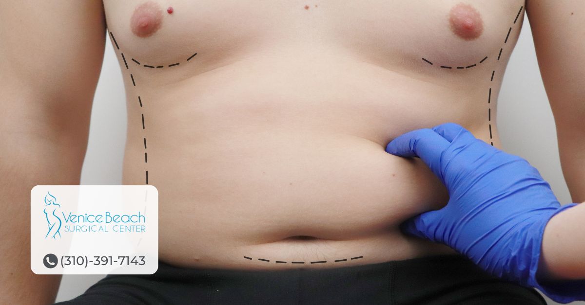 Liposuction HD in Los Angeles