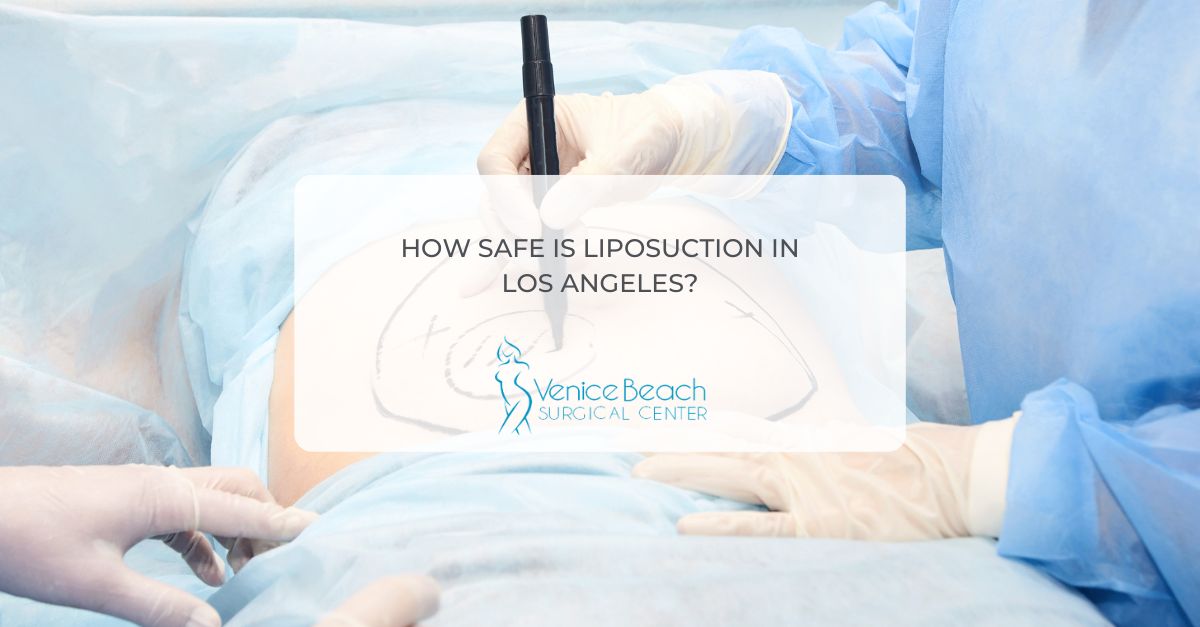 Liposuction in Los Angeles