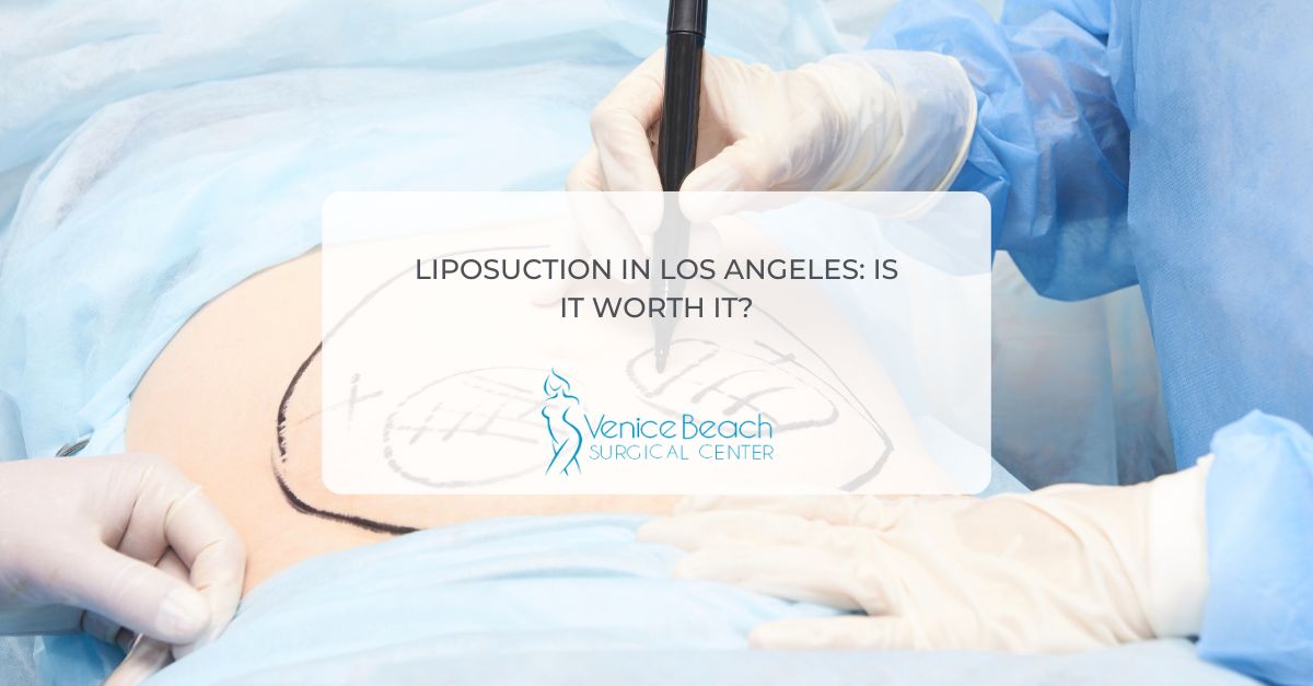 Liposuction Los Angeles